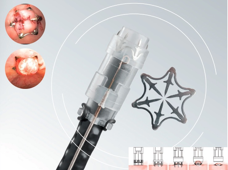 Padlock Clip Defect Closure System Duomed